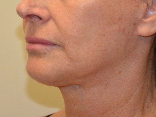 Facelift After Patient 2