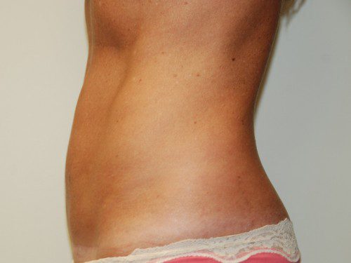 Mini Tummy Tuck After Patient 5