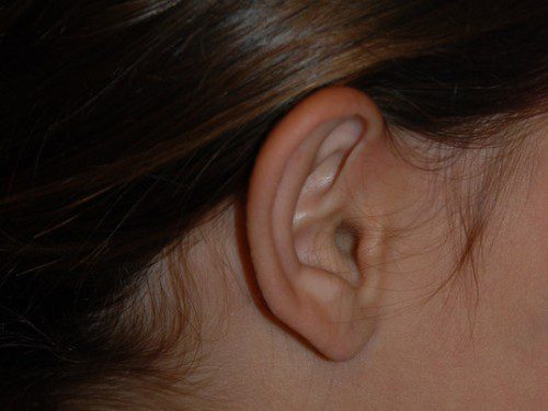 Prominent Ear Surgery Before Patient 4