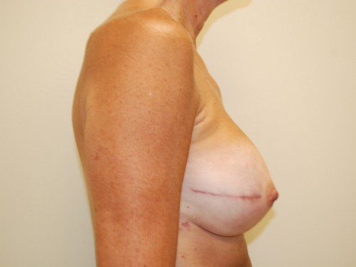 Breast Reconstruction Immediate Implant After Patient 5