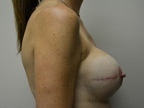 Breast Reconstruction Tissue Expanders After Patient 4