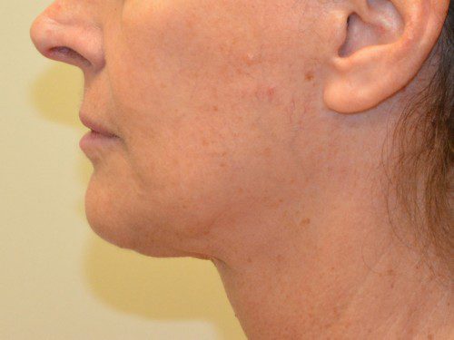 Facelift After Patient 4