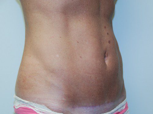 Mini Tummy Tuck After Patient 2