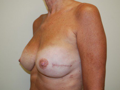 Breast Reconstruction Immediate Implant After Patient 2