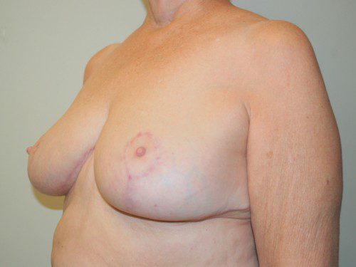 Breast Reduction After Patient 3