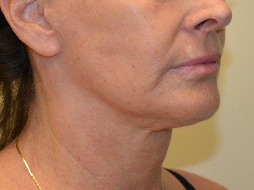 Facelift After Patient 3