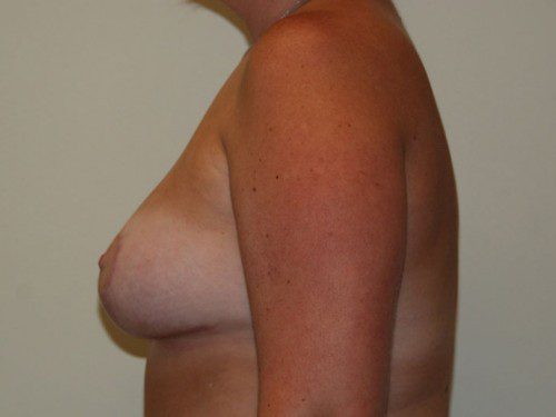 Breast Lift After Patient 5