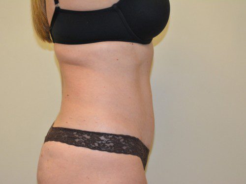 Tummy Tuck After Patient 5