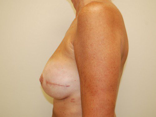 Breast Reconstruction Immediate Implant After Patient 4