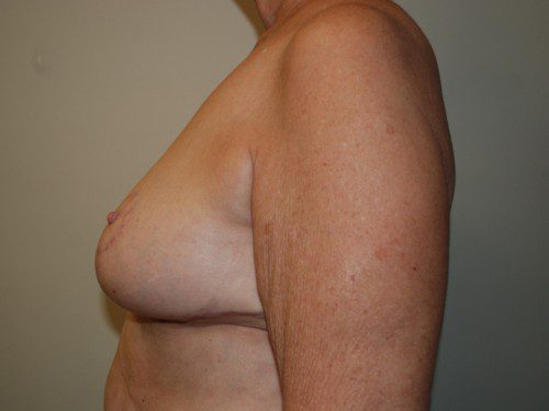 Breast Reduction After Patient 5