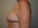 Breast Reduction After Patient Thumbnail 5