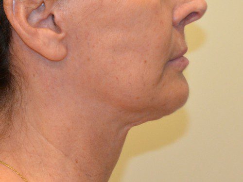 Facelift After Patient 5