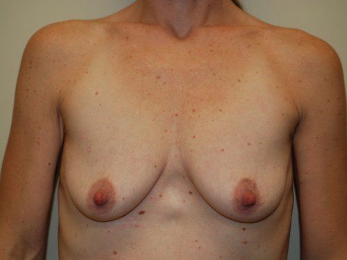 Breast Augmentation w/Lift Before Patient 1