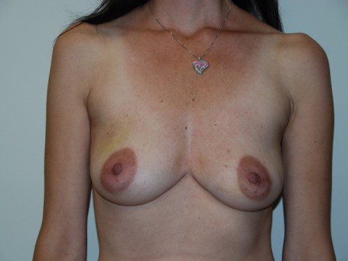 Breast Reconstruction Tissue Expanders Before Patient 1