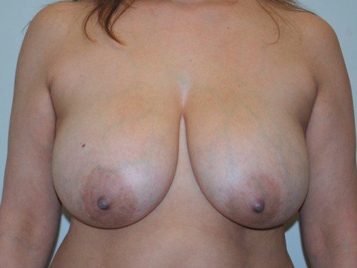 Breast Reduction Before Patient 1