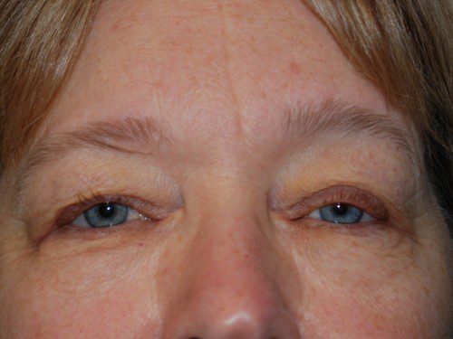 Eyelid Surgery Before Patient 1