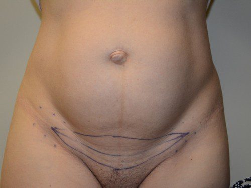 Mini Tummy Tuck Before Patient 1