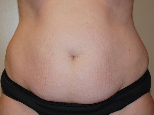 Tummy Tuck Before Patient 1