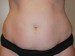 Tummy Tuck Before Patient Thumbnail 1