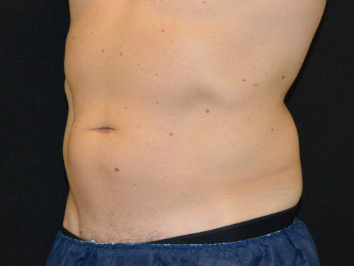 Coolsculpting Before Patient 2