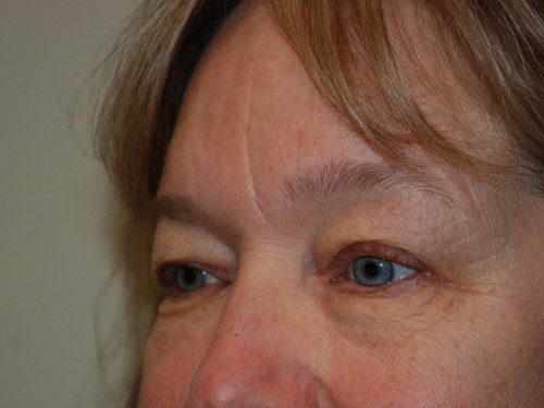 Eyelid Surgery Before Patient 2