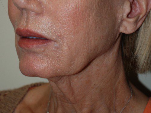 Facelift Before Patient 2