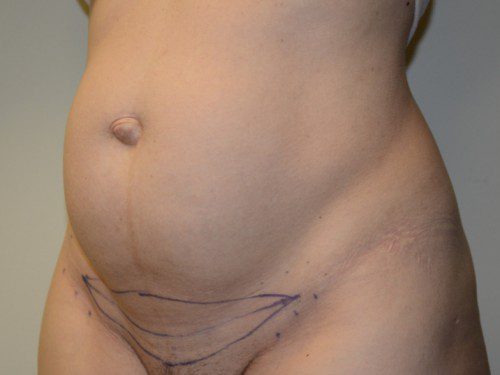 Mini Tummy Tuck Before Patient 2