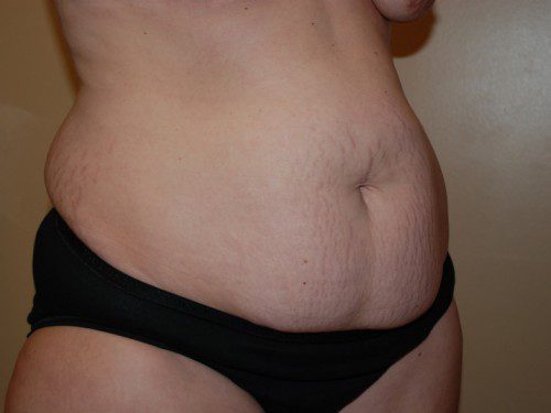 Tummy Tuck Before Patient 2