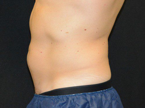 Coolsculpting Before Patient 4