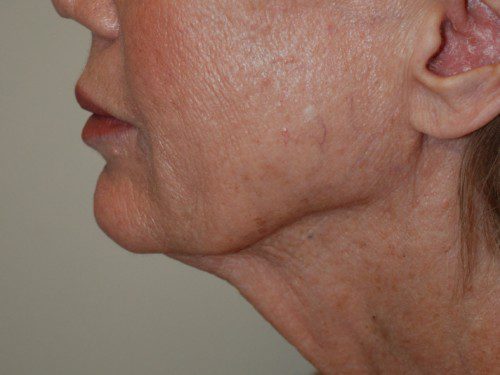 Facelift Before Patient 3