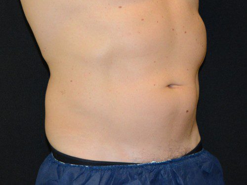 Coolsculpting Before Patient 3