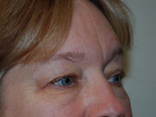 Eyelid Surgery Before Patient 3