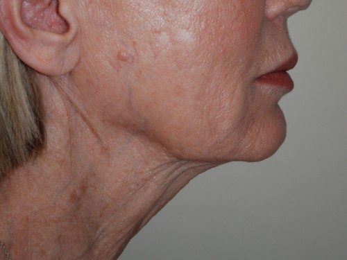 Facelift Before Patient 4