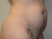 Mini Tummy Tuck Before Patient Thumbnail 3