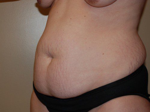 Tummy Tuck Before Patient 3