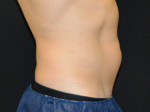 Coolsculpting Before Patient 5