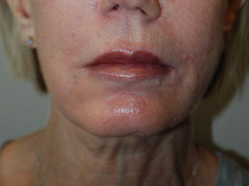 Facelift After Patient 1