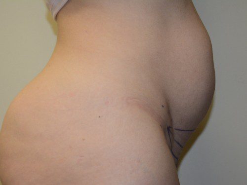 Mini Tummy Tuck Before Patient 5