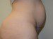 Mini Tummy Tuck Before Patient Thumbnail 5
