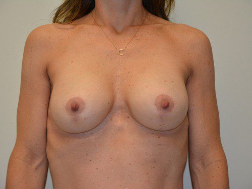 Breast Augmentation w/Lift After Patient 1