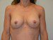 Breast Augmentation w/Lift After Patient Thumbnail 1