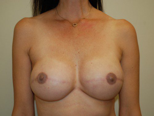 Breast Reconstruction Tissue Expanders After Patient 1