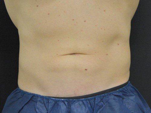 Coolsculpting After Patient 1