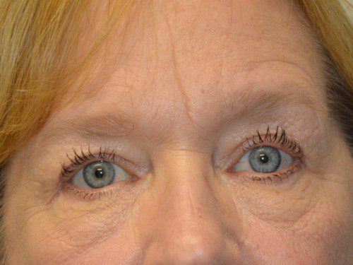 Eyelid Surgery After Patient 1