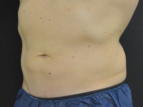 Coolsculpting After Patient 2