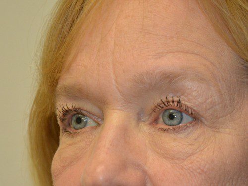 Eyelid Surgery After Patient 2