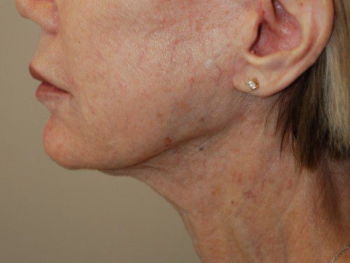 Facelift After Patient 3