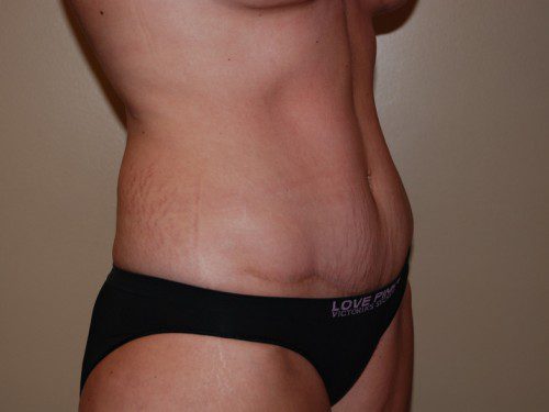 Tummy Tuck After Patient 2