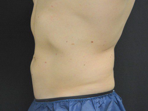 Coolsculpting After Patient 4