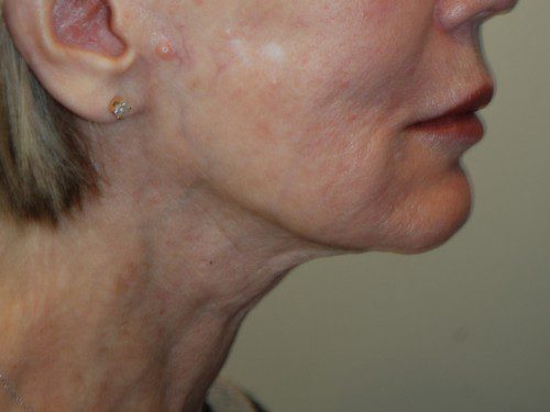 Facelift After Patient 4